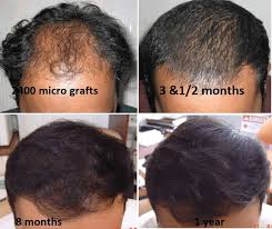 Hair Transplant