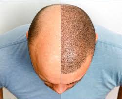 Hair Transplant