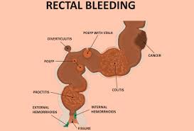 Rectal Bleeding