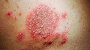 Skin Rashes