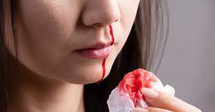 Bleeding