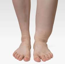 Edema