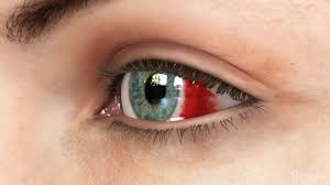Hemorrhage