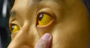 Jaundice