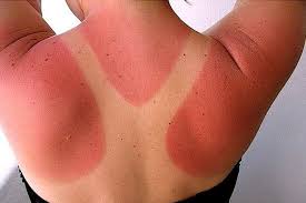 Sun Burns