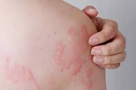 Skin Rashes